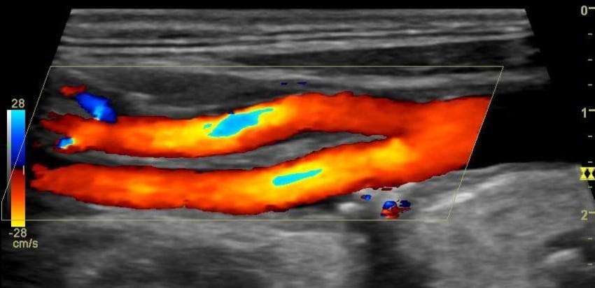 Doppler-Duplex-Sonographie gegen Impotenz