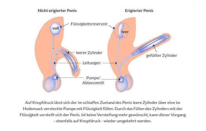 Funktionsweise eines Penisimplantats