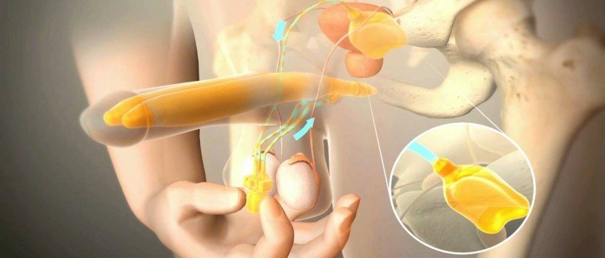 Behandlung von Impotenz durch ein Penisimplantat