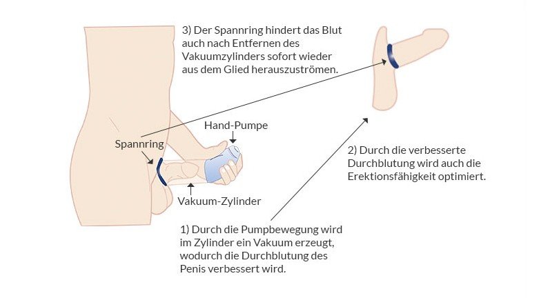 So funktioniert eine Penispumpe