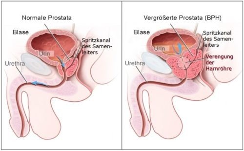 Vergleich normale und vergrößerte Prostata