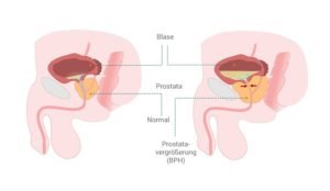 Vergleich normale und vergrößerte Prostata