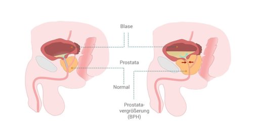Normale und vergrößerte Prostata im Vergleich