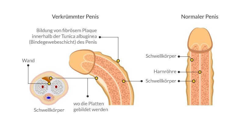 Anatomie einer Penisverkrümmung