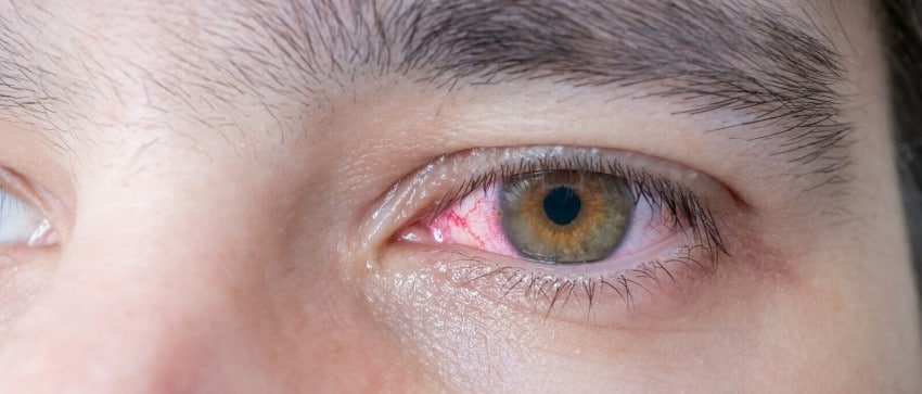 Gerötete Augen als Nebenwirkung von Viagra