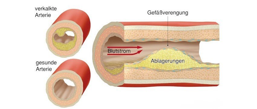 So kommt es zu Gefäßverengungen