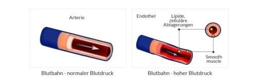 So kommt es zu Hypertonie