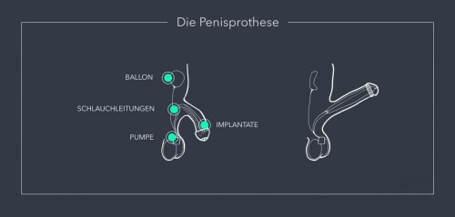 So funktioniert ein Penisimplantat